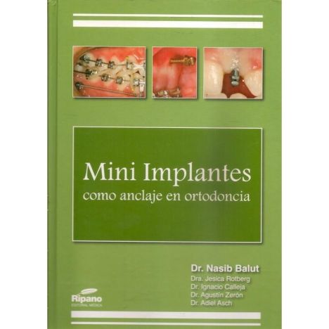 MINI IMPLANTES COMO ANCLAJE EN ORTODONCIA