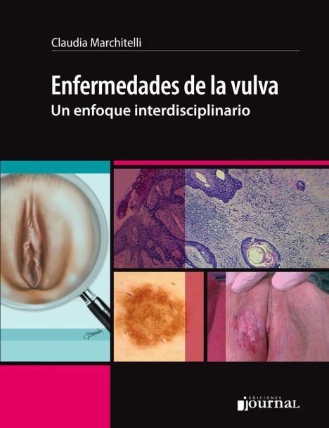ENFERMEDADES DE LA VULVA - UN ENFOQUE MULTIDISCIPLINARIO