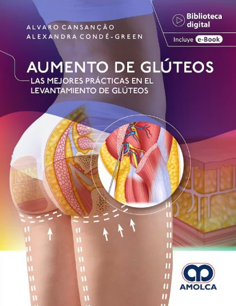 AUMENTO DE GLÚTEOS. LAS MEJORES PRÁCTICAS EN EL LEVANTAMIENTO DE GLÚTEOS